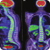 Positron Emission - Tomography (PETCT)