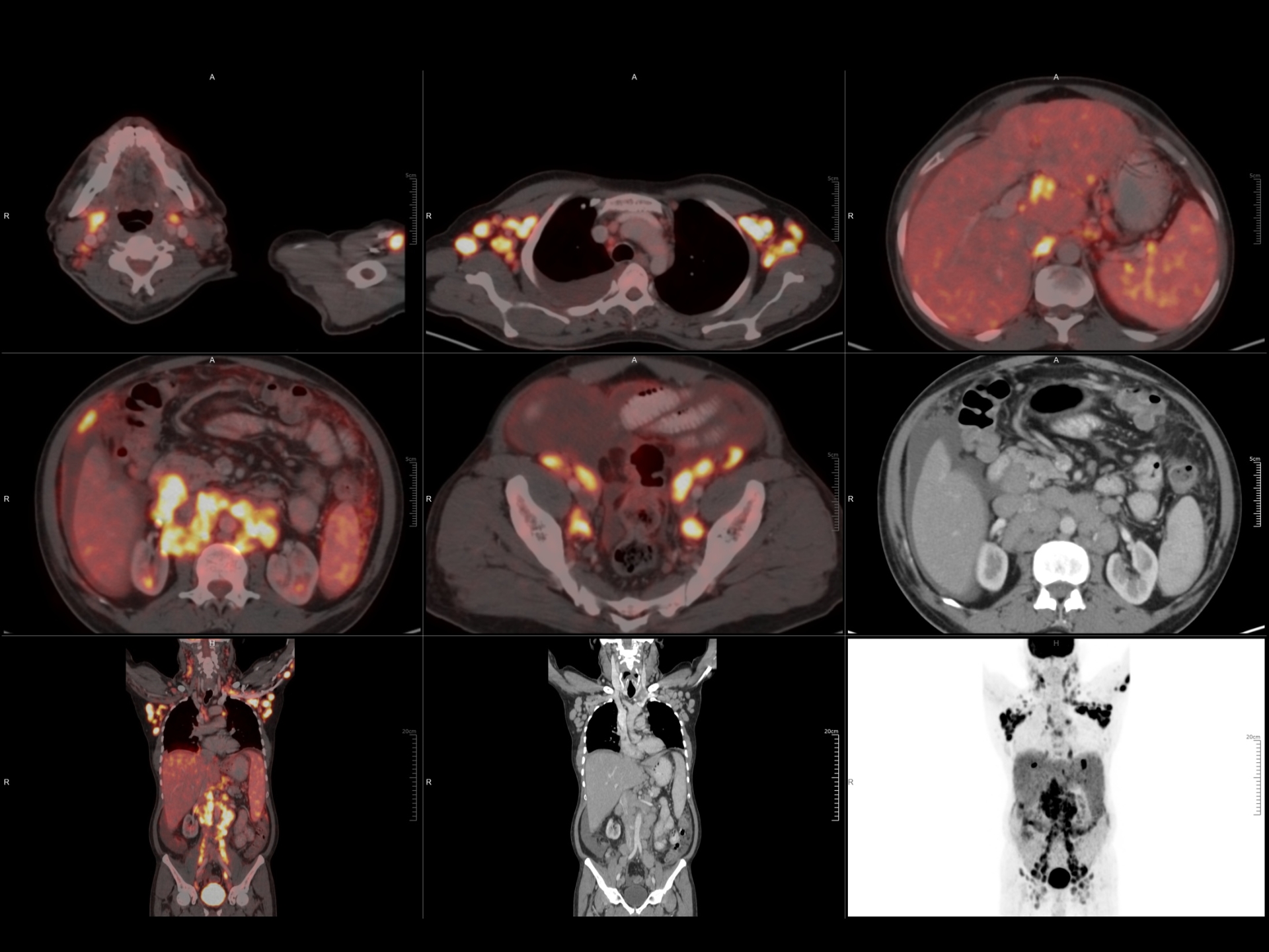 pet-ct