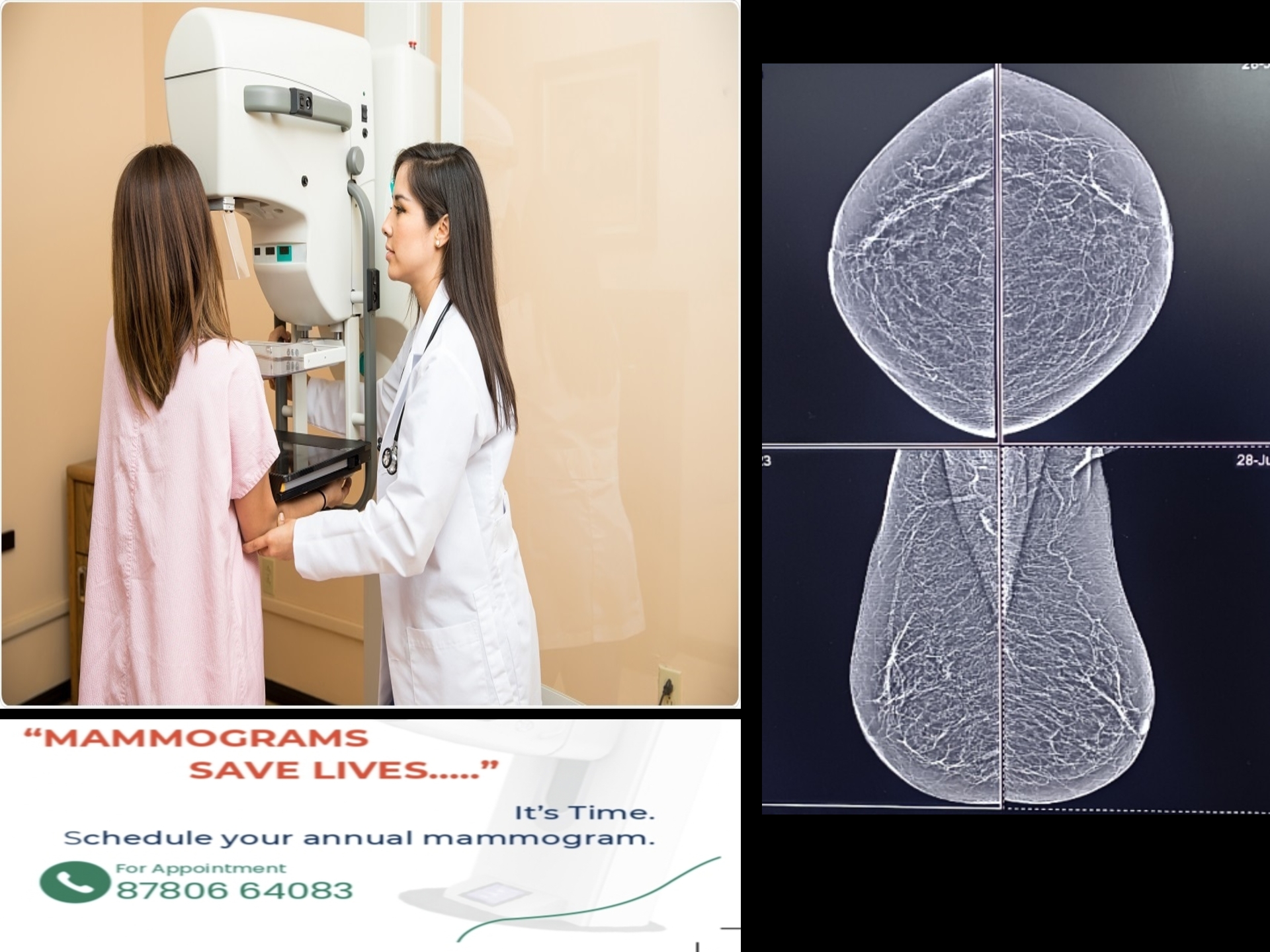 mammography